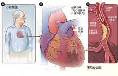 冠心病的起因是什么？