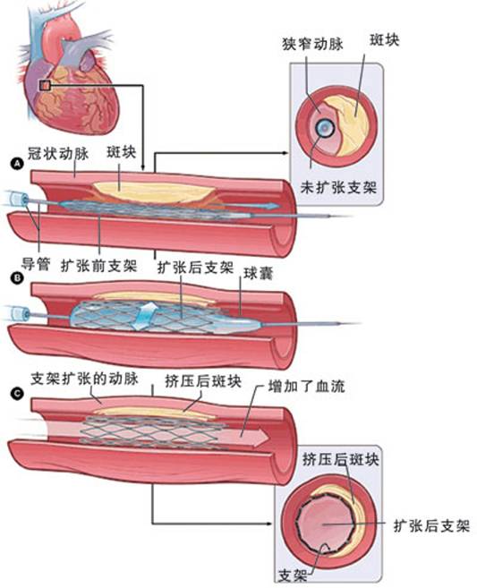 怎樣治療冠心??？(圖2)